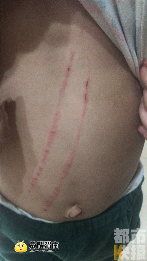 西安一品格幼儿园男童肚皮有血道疑遭踢打 老