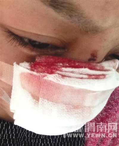 女子遭家暴被丈夫割鼻子:他说鼻子最好看(图) 女子遭家暴被丈夫割鼻子:他说鼻子最好看(图)